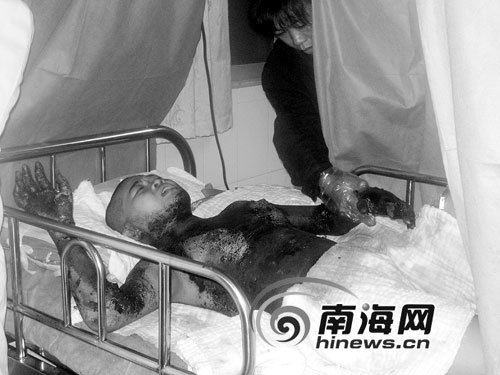 少女爱闻汽油惹火烧身 上半身被烧焦(图)