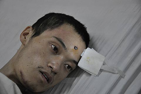 男子头插3枚铁钉急待手术 一言不发身份成谜