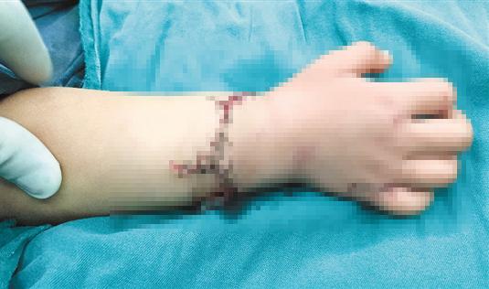 5岁女孩右手腕被连根切断 争分夺秒6小时重接断掌