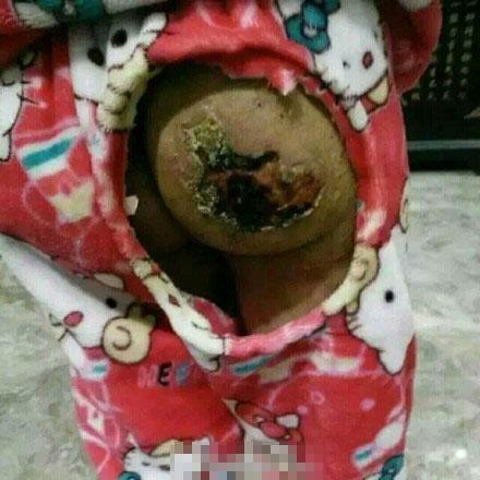 安徽6岁女童疑遭亲母及其情人虐待：双手放开水泡