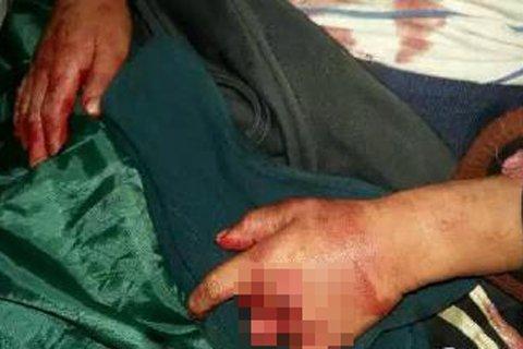 湖南6岁男童因吵女子睡觉被砍断手指和生殖器