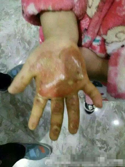安徽6岁女童疑遭亲母及其情人虐待：双手放开水泡