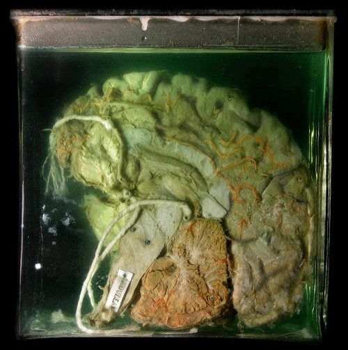 浸泡在福尔马林溶液中的大脑样本(资料图)