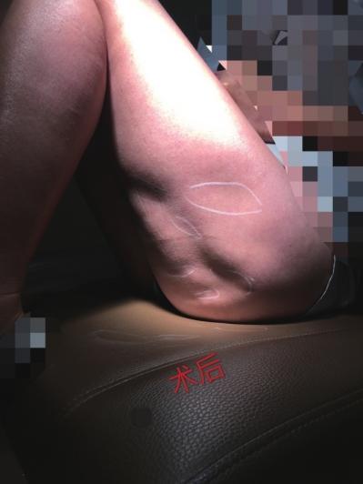 北京醫院回應“女子豐臀失敗致大腿凹凸不平”