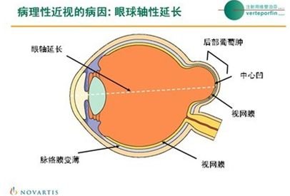 保健养生:正确预防病理性近视并发症