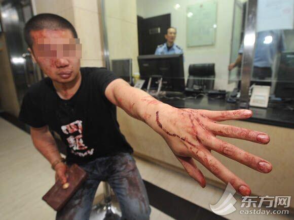 上海市民乘车遭老外无端暴打 眉骨开裂鼻骨骨折