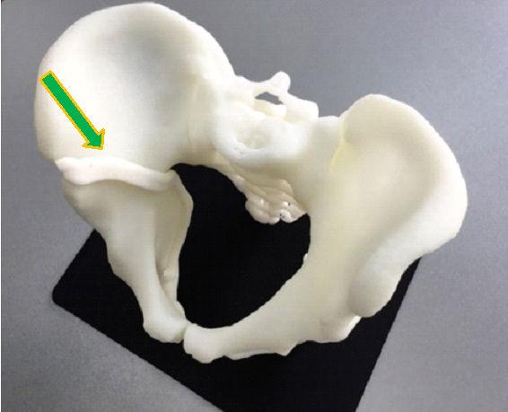 医生将3D打印技术用于髋关节手术 患者5天可