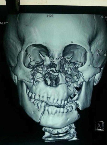 男孩脸部骨头裂成100多块 将接受拼脸手术