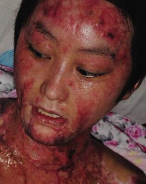 安徽被毁容少女谈判决:可能我还没出院他已出狱