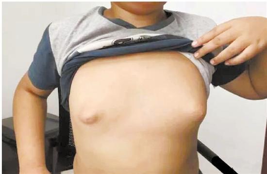 姐弟俩乳房发育过大 姐姐一个胸有6斤重(图)
