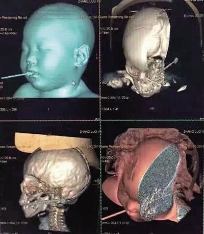 奶奶和孙子玩吃饭游戏 男童摔倒筷子插入口腔12厘米