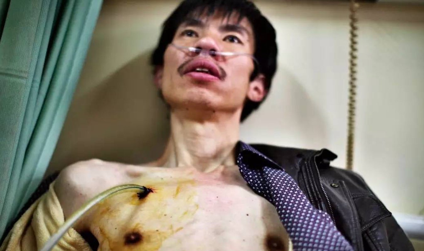 当时他的肺泡已经破裂,对肺部造成了压力。医生在他的胸腔上切开一个小口,把一根塑料管插到他右边的肺腔里,通过按压把肺里的空气排出来。《一个尘肺病家庭的爱与绝望》,河南/陕西,2011-2013 当时他的肺泡已经破裂,对肺部造成了压力。医生在他的胸腔上切开一个小口,把一根塑料管插到他右边的肺腔里,通过按压把肺里的空气排出来。《一个尘肺病家庭的爱与绝望》,河南/陕西,2011-2013