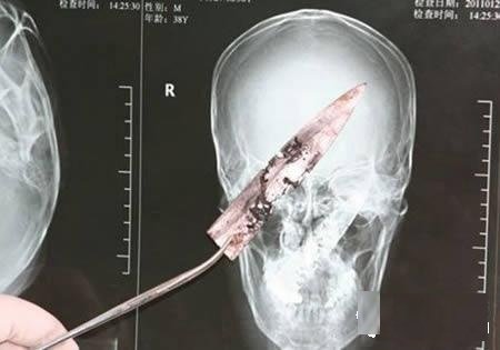 震撼组图:超牛X光片 自慰品竟落身体里!_新闻