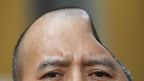 美国一男子劝架被削掉半边脑颅 获天价赔偿(图