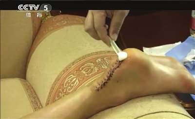 刘翔创口很大。央视截