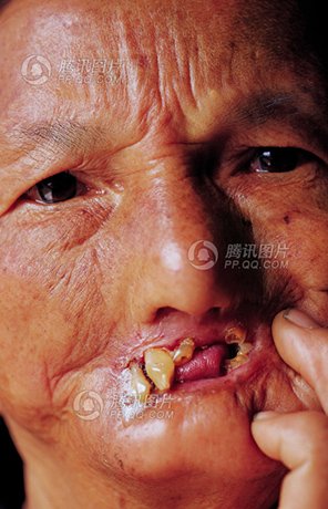 徐丙翠:<em>失去味觉</em>_幸存者_腾讯网