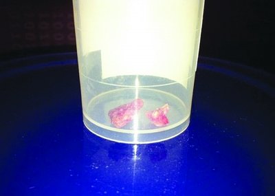 刘翔脚踝取出的钙化点