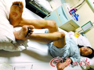 男子疑<em>女友</em>不忠虐待两昼夜 用打火机烧脚底(图