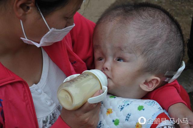 小孩似外星人无钱治 妈妈注射器抽积液