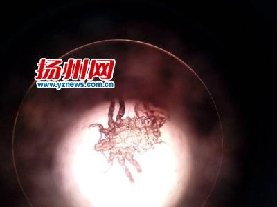 4岁女童左眼瘙痒数月 系虱子藏睫毛根部吸血