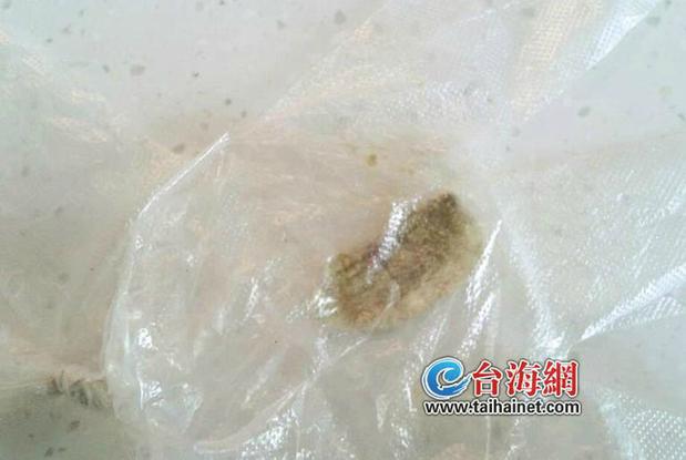 患者打喷嚏喷出棉花团 3年前曾做过鼻窦炎手术