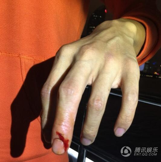 谢霆锋手指被螃蟹钳出血 或需做手术取出异物