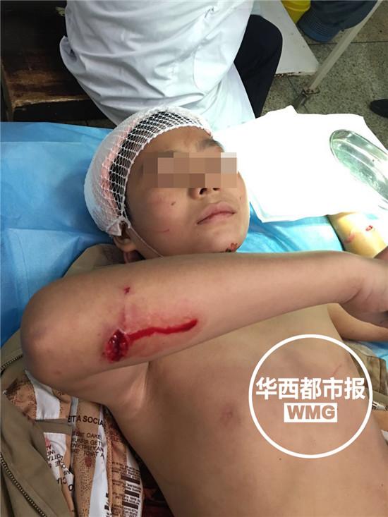 12岁男孩放学路上遭猴群围攻 全身10多处受伤