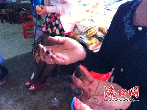 海口女子患红斑狼疮手指溃烂如焦炭 四处求医