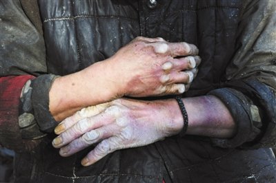 北京一黑豆腐作坊内智障劳工被虐致死