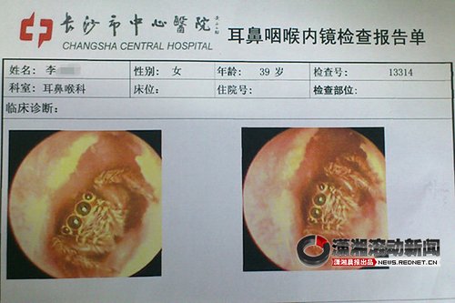 长沙一女子耳道藏活蜘蛛 医院检查被吓哭()