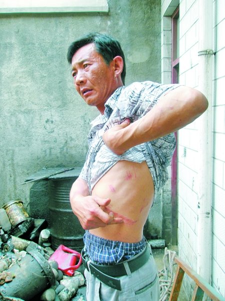 郑海军救人时留下的伤痕