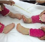 河南双胞胎女童患怪病 头颅畸形手脚像
