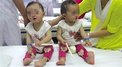 河南双胞胎女童患怪病 头颅畸形手脚像
