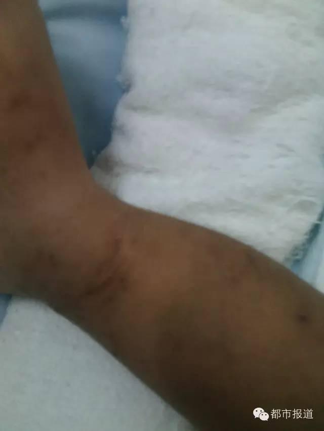 只因偷情时哭闹，洛阳2岁女童遭妈妈情夫捆绑虐打 生命垂危&hellip;&hellip;