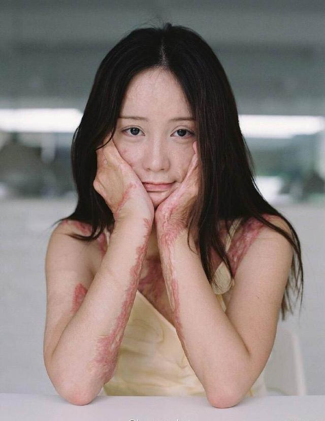 “毁容少女”:心里没有恨 不和肇事者一般见识
