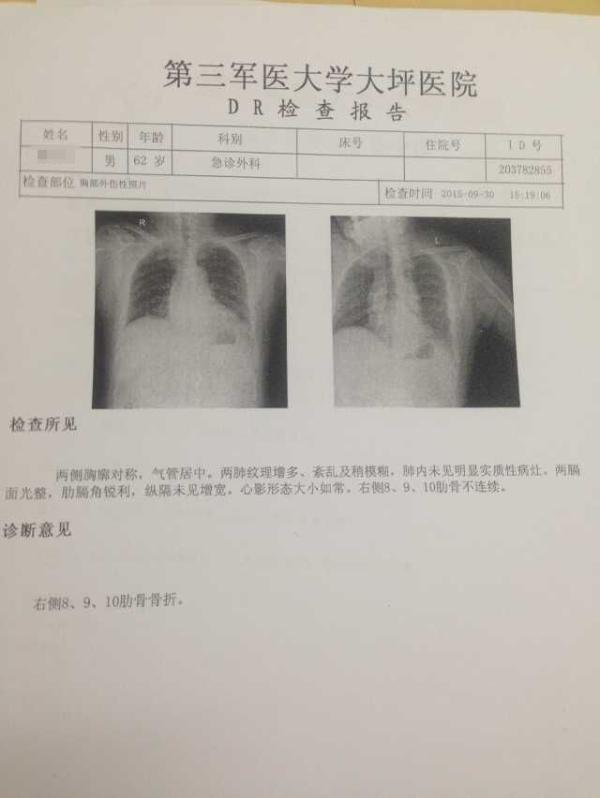 62岁的熊某某右侧8,9,10肋骨骨折