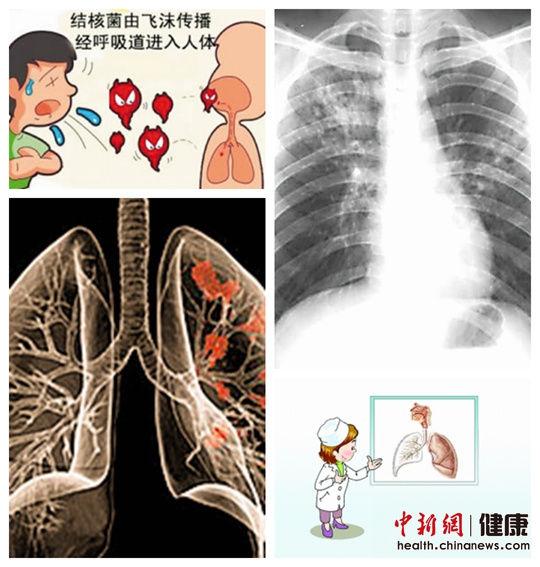 我国肺结核患者数量居世界第二位春季呼吸道疾病易复发