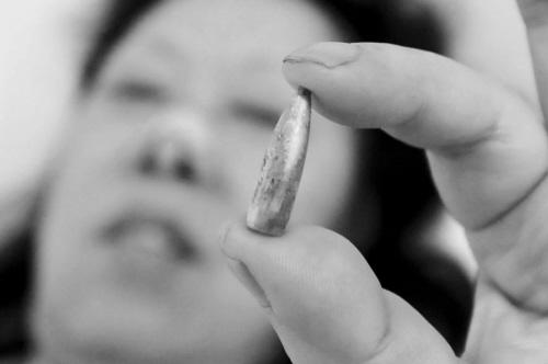 女子曾被飞来“石子”击中头部 鼻腔存留子弹47年
