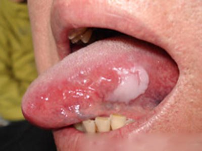由真菌感染引起的白色斑块,犹如雪花层层叠叠,多发于颊舌,软腭及口唇