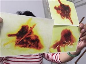 女子遭寄生虫困扰4年 <em>揉</em>鼻搓<em>头发</em>会掉下白虫卵