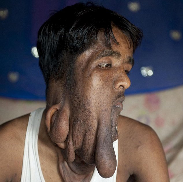 印度男子切除脸部巨型肿瘤 盼找到真爱(图)