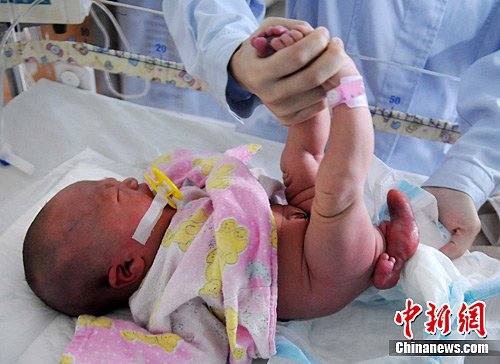 湖南省儿童医院收治一名臀部长“腿”女()