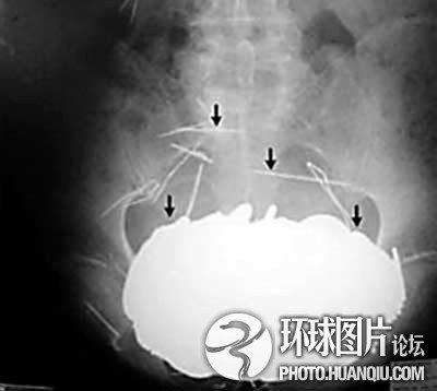 全球五花八门的异食癖