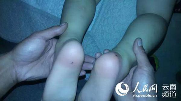 云南个旧4岁男童双脚被扎进两厘米牙签