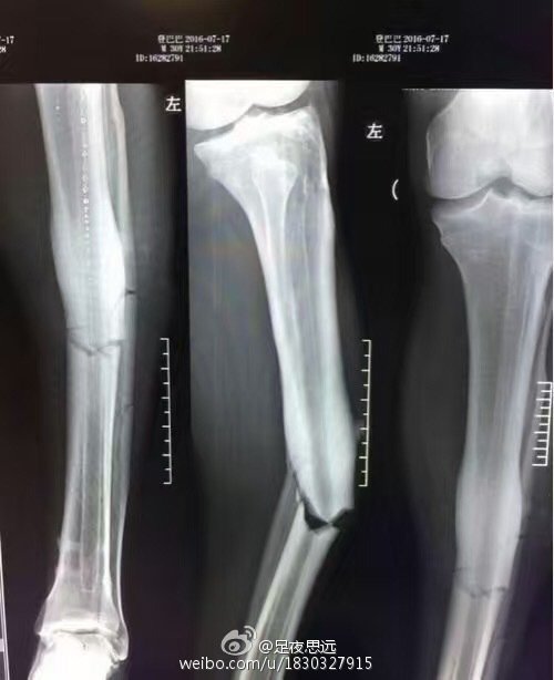触目惊心!登巴巴断腿X光曝光 小腿两根骨头折