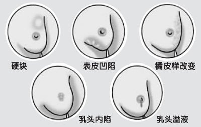 <em>女性</em>保健:<em>乳房</em>的12种疾病征兆