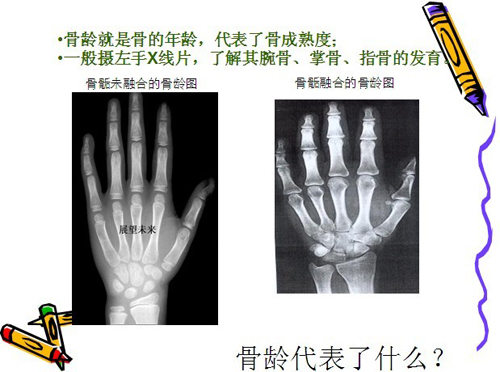 测骨龄就是通过手掌X光片确定被测者骨年龄 测骨龄就是通过手掌X光片确定被测者骨年龄
