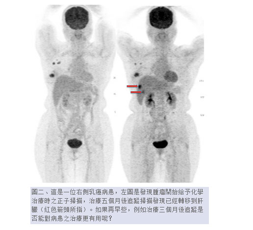 如这篇台湾医学论文截图里的用法,PET-CT技术主要在癌症治疗中大显身手 如这篇台湾医学论文截图里的用法,PET-CT技术主要在癌症治疗中大显身手