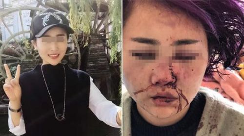 女游客琳哒被打前后对比 女游客琳哒被打前后对比