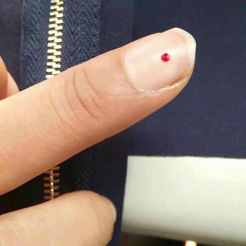 被缝纫机针头扎出血的指头